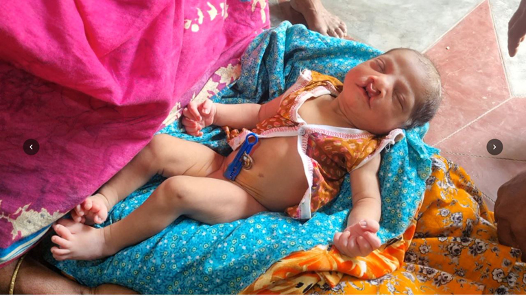 ফুলবাড়ীতে ২৮টি নখ নিয়ে জন্ম নবজাতকের :  কন্যাসন্তান পেয়ে আনন্দ, তালুর জটিলতায় দুশ্চিন্তায় পরিবার